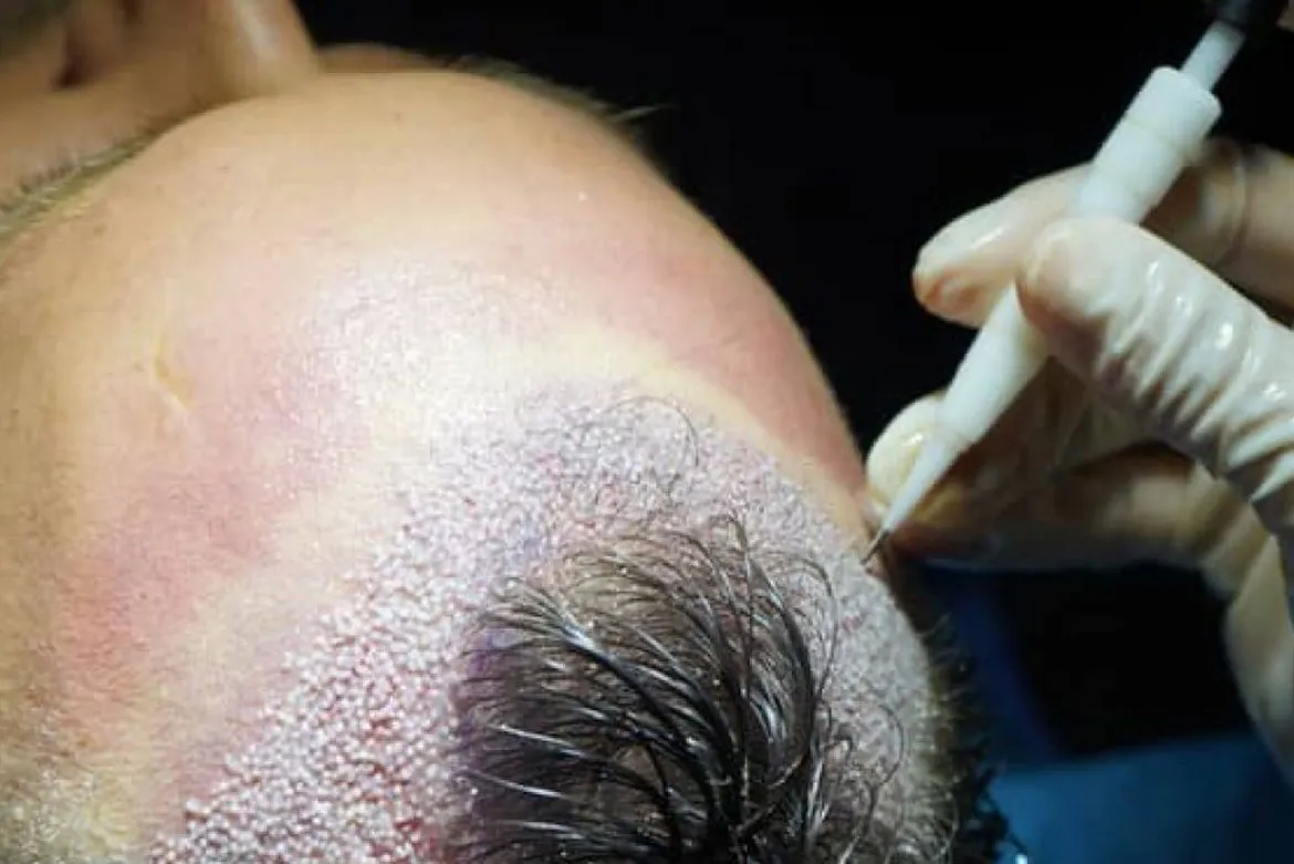 زراعة الشعر بتقنية DHI