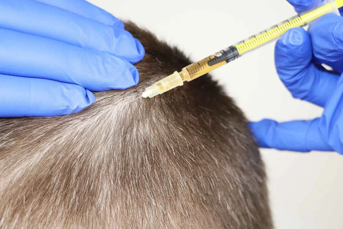 جلسات الميزوثيرابي للشعر